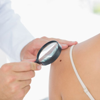 Moles or Skin Cancer: How to Tell the Difference