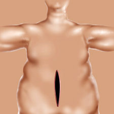 Bariatric Surgery